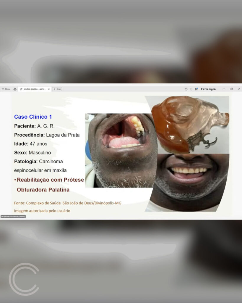 cssjd-se-consolida-como-referencia-nacional-em-prevencao-e-reabilitacao-de-cancer-de-boca-apos-destaque-em-webinar-do-ministerio-da-saude