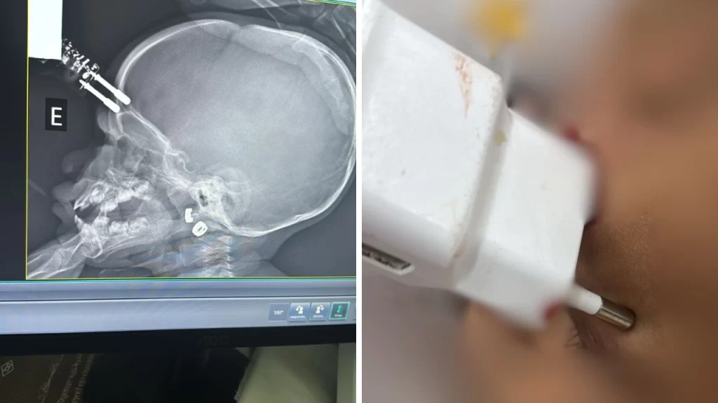 cena-forte:-neurocirurgiao-explica-como-salvou-crianca-com-carregador-na-testa