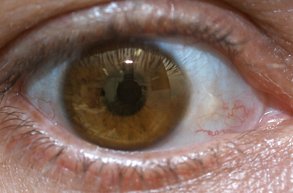 fundacao-ezequiel-dias-ira-produzir-medicamento-para-degeneracao-macular