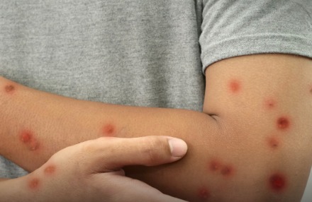 alerta-de-saude:-minas-gerais-confirma-os-primeiros-casos-de-mpox-em-2026;-saiba-onde-foram-registrados