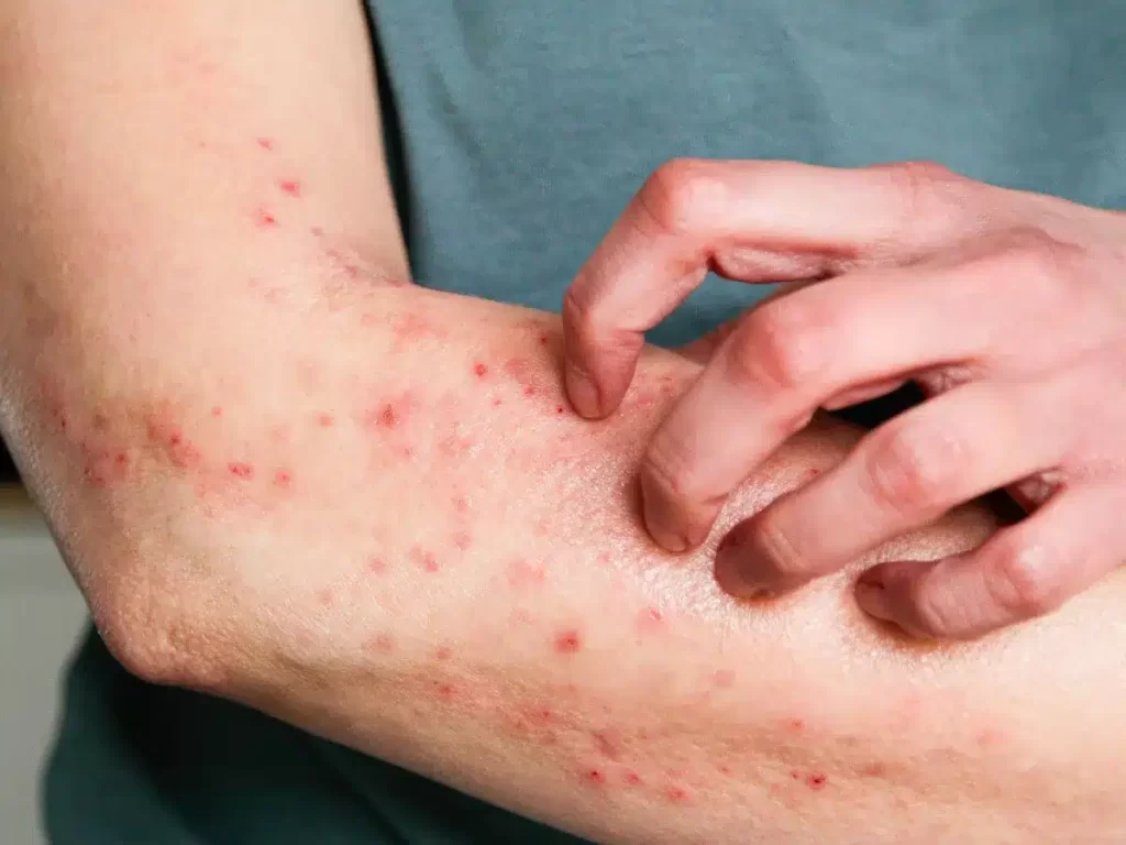 governo-de-minas-gerais-confirma-tres-casos-de-mpox-na-regiao-metropolitana-de-belo-horizonte